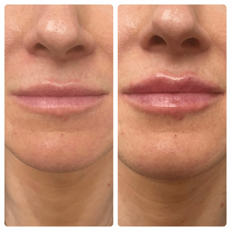 1/2 Syringe Lip Filler Before and After