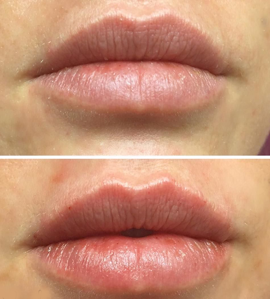 1/2 Syringe Lip Filler Before and After