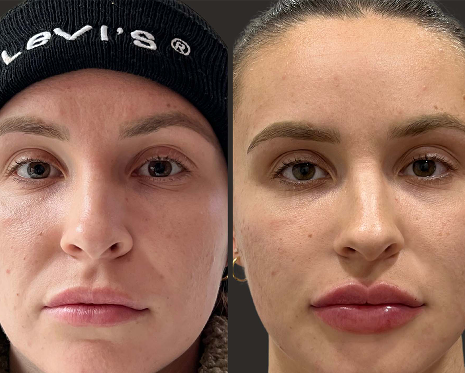 2ml Lip Filler Before and After