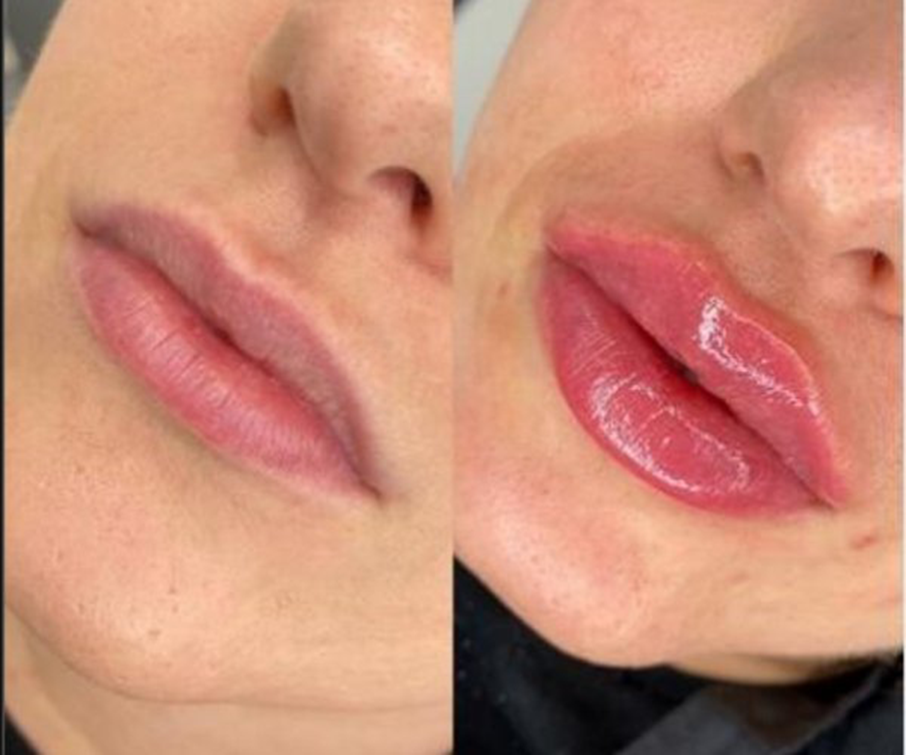 2ml Lip Filler Before and After