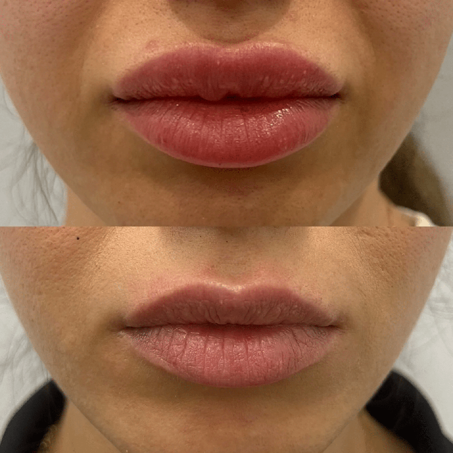 Dissolving Filler Before and After