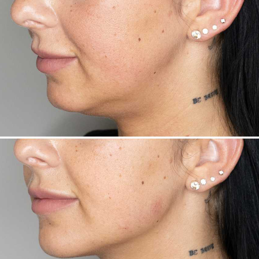 Jawline Filler Before and After