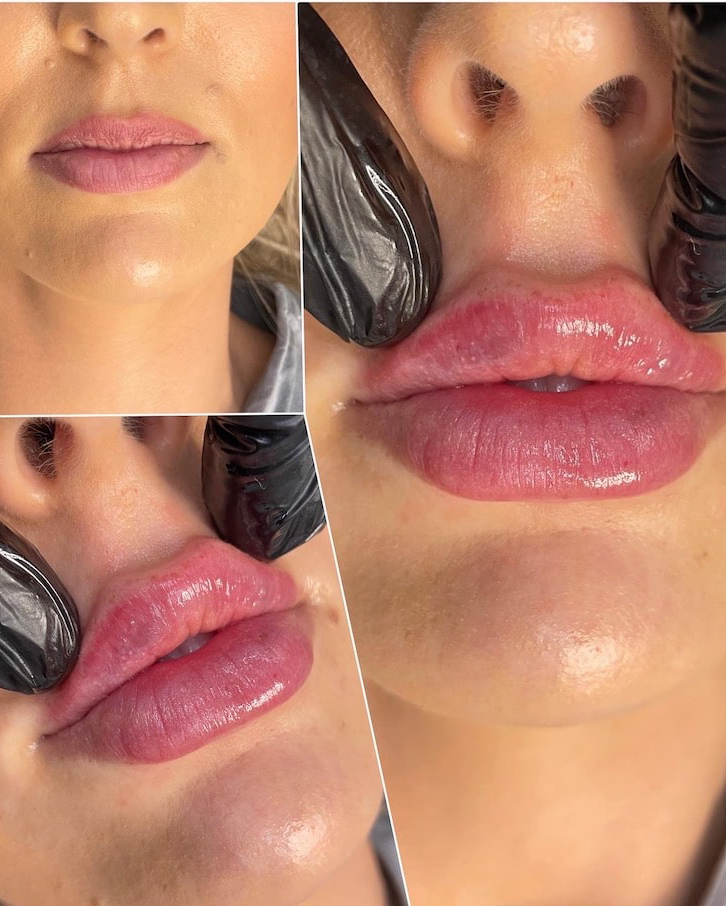 Lip Filler Before and After