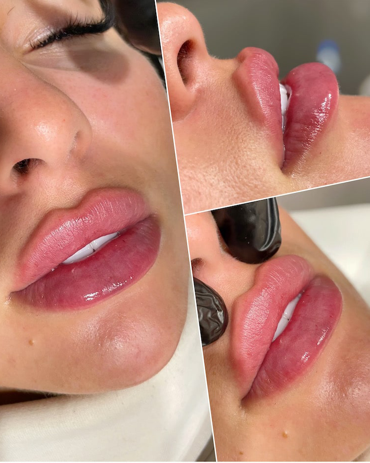 Lip Filler Before and After