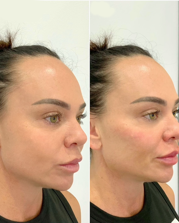 Cheek Filler Before and After