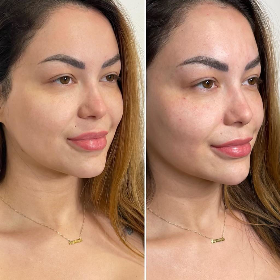 Cheek Filler Before and After