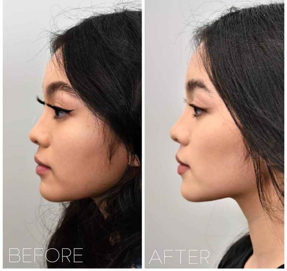 Chin Filler Before and After
