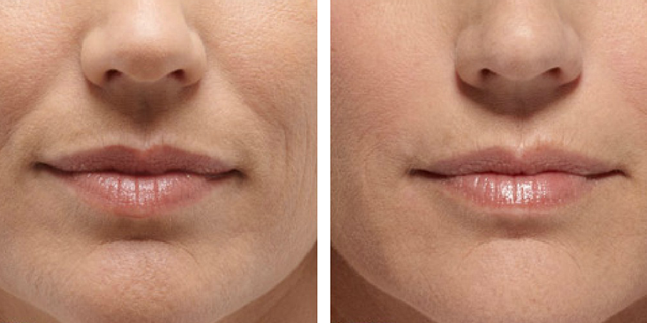 Filler Around Mouth Before and After