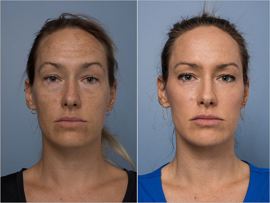 Forehead Filler Before and After