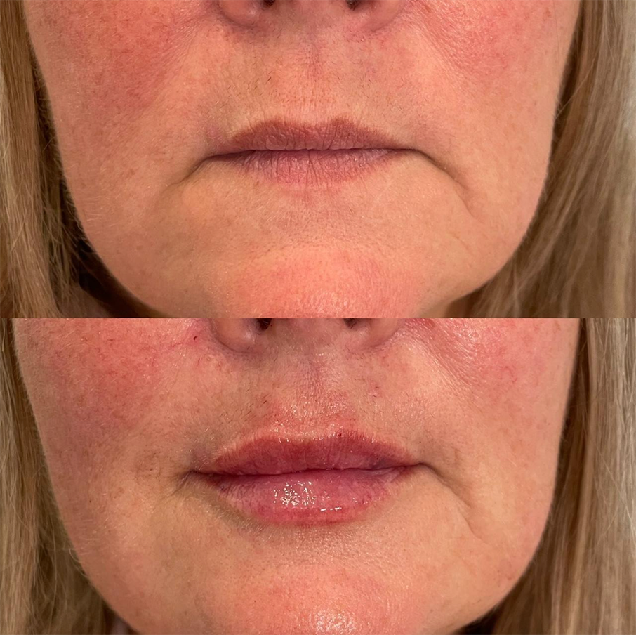 Natural Lip Filler Before and After