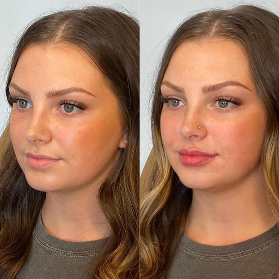 Natural Lip Filler Before and After